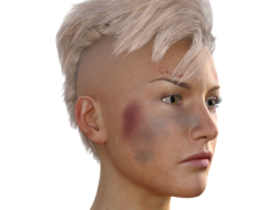 Ketahui Ini Penyebab Memar Tanpa Sebab pada Tubuh, Diantaranya Diabetes